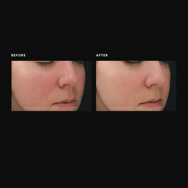 PCA Skin Dual Action Redness Relief 1 oz.