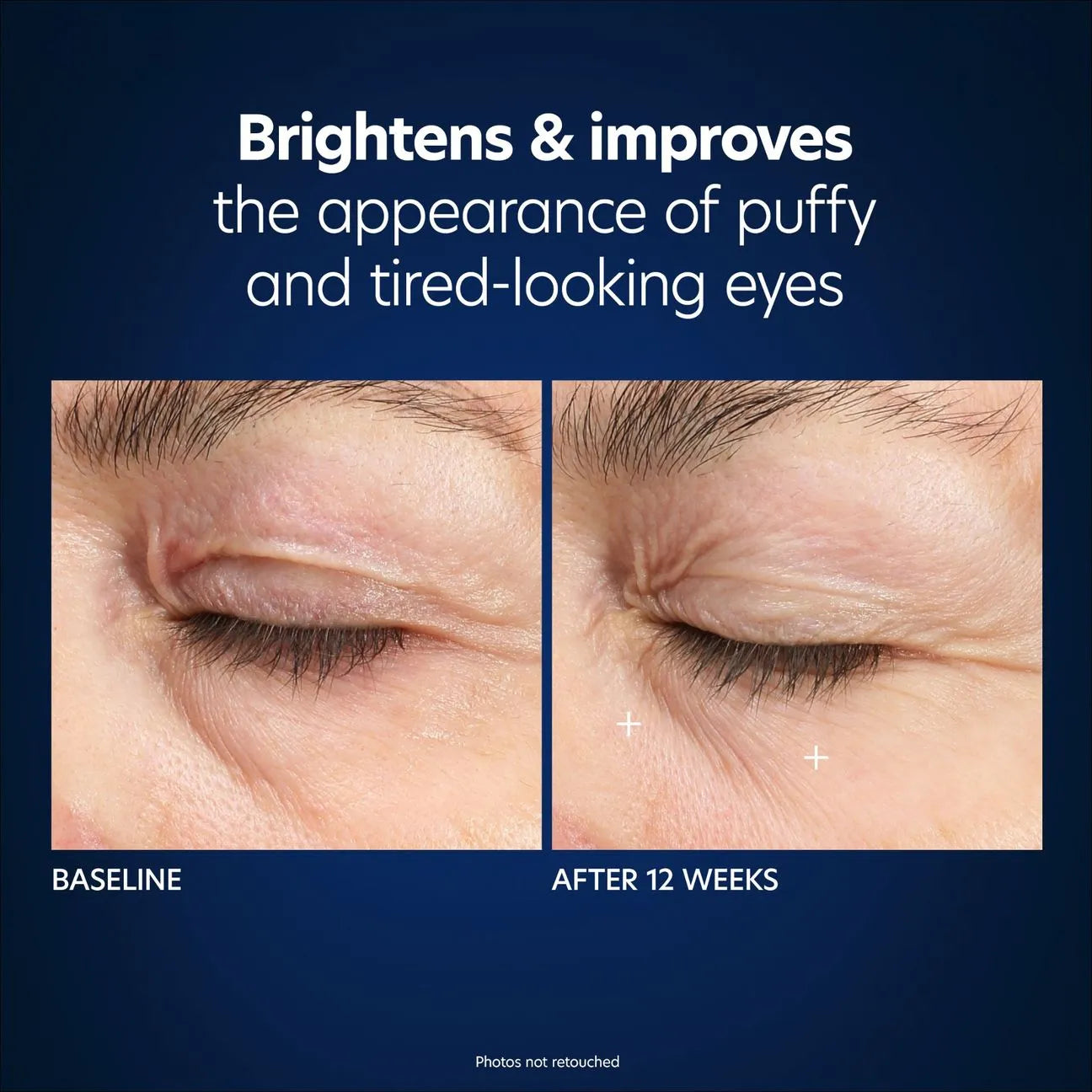 PCA Skin Hyaluronic Acid Microneedle Eye Patches 4 pack